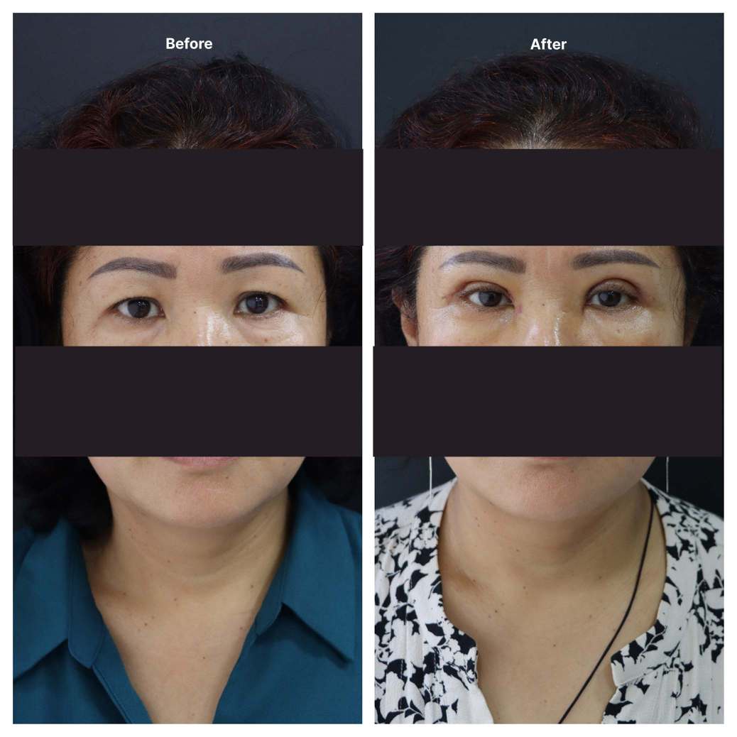 Eyelid Surgery KOQ10
